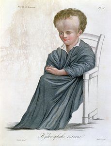 Wodogłowie wewnętrzne, z Nosologie Naturelle Barona Jean Louis Alibert (1768-1837) grawerowane przez Tresca, 1817 autorstwa French School