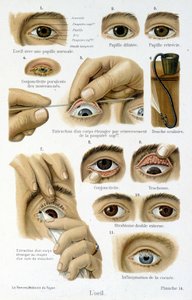 Medycyna: oko. autorstwa French School