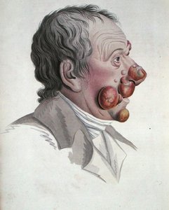 Mycosis Fongoide, z książki barona Jeana Louisa Aliberta (1768-1837) 1838 (rycina kolorowana) autorstwa French School