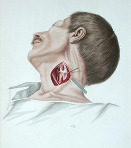 Operacja tętniaka, z „Selecta Praxis Medico-Chirurgica” Alexandra Ouverta, Paryż autorstwa French School