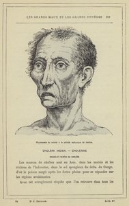 Fizjonomia chorego w okresie asfiksji cholery (kolor lito) autorstwa French School