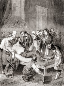 Pierwsza publiczna demonstracja użycia wziewnego eteru jako chirurgicznego środka znieczulającego w 1846 r. przez amerykańskiego dentystę Williama Thomasa Greena Mortona z „Les Merveilles de la Science”, opublikowana ok. 1870 r. autorstwa French School