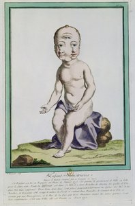 Dziecko ze zdeformowaną głową, z „Les Ecarts de la Nature”, Paryż, 1775