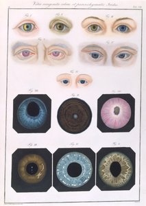 Opis wrodzonych anomalii oka, z Obrazów klinicznych chorób i wad wzroku ludzkiego oka, Friedrich August von Ammon (1799-1861) 1838 autorstwa German School