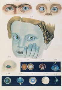 Opis wrodzonych anomalii oka, z Obrazów klinicznych chorób i wad wzroku ludzkiego oka, Friedrich August von Ammon (1799-1861) 1838 autorstwa German School