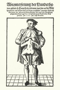 Hans Kaltenbrunn i jego nierozwinięty bliźniak syjamski (rycina) autorstwa German School