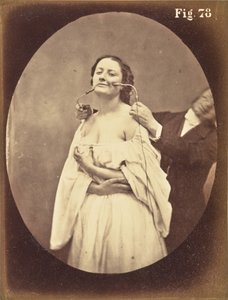 Rys. 78 autorstwa Guillaume Benjamin Duchenne