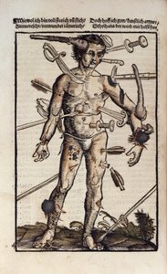 XVIIIv Ranny człowiek, z „Feldtbuch der Wundartzney” Hansa von Gersdorffa autorstwa Hans or Johannes Ulrich Wechtlin