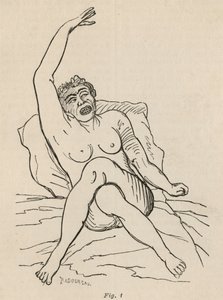 Epilepsja histeryczna, atak, skurcze, rys. 1 z "Iconographie Photographique de La Salpetriere" Bourneville et P. Regnard, Paryż, 1876