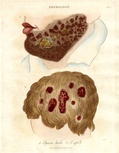 Ilustracja patologiczna grzybicy jęczmienia i grzybicy włosowatej autorstwa John Pass