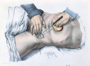 Podwiązanie tętnicy, tablica z "Traite Complet de l