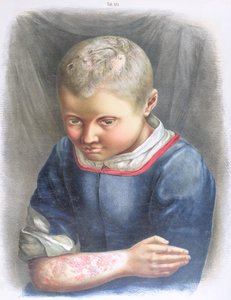 Favus, z książki Daniela Corneliusa Danielssena (1815-94) 1892 autorstwa Norwegian School