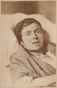 Epilepsja histeryczna, skurcz twarzy, płyta VIII z "Iconographie Photographique de La Salpetriere" Bourneville et P. Regnard, Paryż, 1876 (odbitka albuminowa) autorstwa Paul Regnard