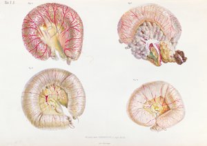 Zewnętrzna powierzchnia jelit zakażonych cholerą, z Anatomie Pathologique du Cholera Morbus, Nikołaja Iwanowicza Pirogowa (1810-81) opublikowanej w Petersburgu, 1849 autorstwa Russian School