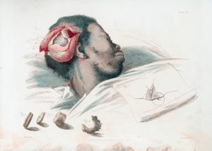 Widok rany w czaszce po trefinacji i usunięciu rozbitego kawałka kości w lewym dolnym rogu, 1821 autorstwa Thomas Landseer