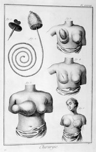 Operacja piersi, 1751-1777 autorstwa Unbekannt