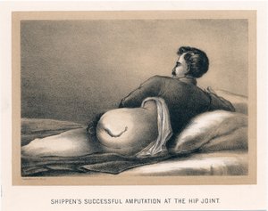 Shippens udana amputacja stawu biodrowego, wojna secesyjna, 1865 autorstwa Unbekannt