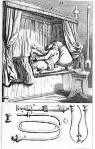 Clystère (do lewatyw) Johannesa Sculptetusa „”Armamentarium Surgical””. Wenecja 1665 autorstwa Unknown artist