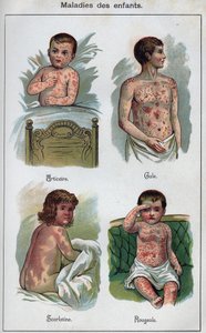 Choroby dzieci: pokrzywka, odra, świerzb, szkarlatyna. W „Nowym naturalnym leku” F.E. Bilz. autorstwa Unknown artist