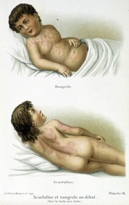 Szkarlatyna i odra - XIX wiek autorstwa Unknown artist