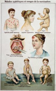 Tablica ilustrująca różne akademiki chorób syfilitycznych i niebezpieczeństwa szczepień - w Bilz medycyna naturalna, koniec XIX wieku. autorstwa Unknown artist