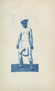 Elephantiasis, c. 1870 (zdjęcie) autorstwa Unknown photographer