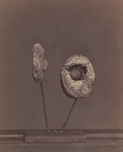 Wycięty staw kolanowy. Okrągła kula muszkietu w wewnętrznym kłykciu prawej kości udowej [Gardin..., 1866-67.