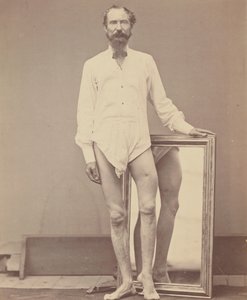 Rana postrzałowa środkowej trzeciej lewej kości udowej, 1865-67.