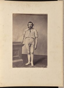 Udane wycięcie głowy lewej kości udowej z powodu złamania postrzałowego autorstwa William H. Bell
