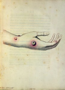 Krosta krowianki na ramieniu Sarah Nelmes, z „Aninquiry into the Causes and Effects of the Variolae Vaccinae” Edwarda Jennera (1749-1823), grawerowana przez Pearce
