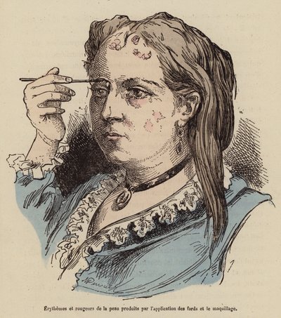 Kobieta z wysypką i zaczerwienieniem skóry spowodowanymi stosowaniem makijażu (kolorowy grawerunek) autorstwa (after) French School