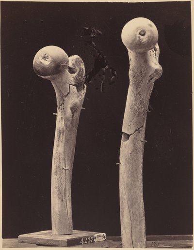 Okazy złamań kości udowej od postrzału, ok. 1867 (zdjęcie) autorstwa American Photographer