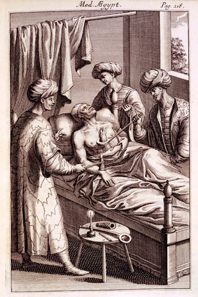 Ilustracja moxibustion z Medicina Aegyptorum autorstwa Prospero Alpinusa, 1745 autorstwa American School