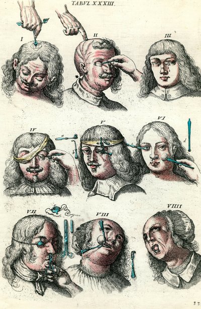 Chirurgia w XVIII wieku: Trepanacja i operacja oka i twarzy. Grawerowanie w „Institutions chirurgicale” Lorenza Heistera autorstwa Anonymous Anonymous
