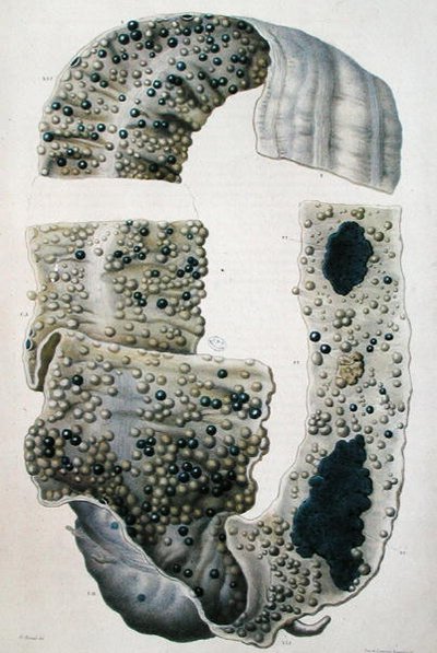 Choroby jelit, z „Anatomie Pathologique du Corps Humain” Jeana Cruveilhiera (1791-1874) 1828-42 (kolorowa grawerunek) autorstwa Antoine Chazal