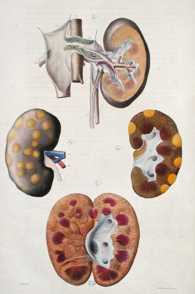 Choroby nerek, z „Anatomie Pathologique du Corps Humain” Jeana Cruveilhiera (1791-1874) 1828-42 (kolorowe grawerowanie) autorstwa Antoine Chazal