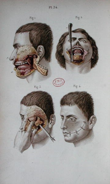 Anatomiczna płytka górnej szczęki autorstwa C and Huette E. Bernard