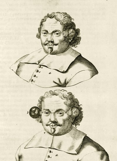 Przykład bańki, z The Practice of Medicine Frederika Dekkersa, 1694 autorstwa Dutch School