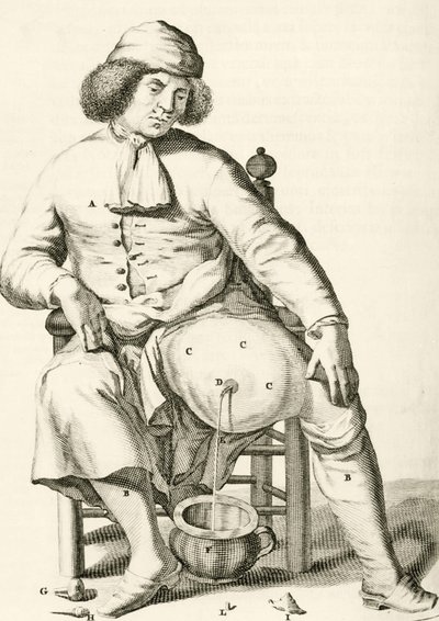 Odprowadzanie płynu z ropnia przez Frederika Dekkersa, 1694 autorstwa Dutch School