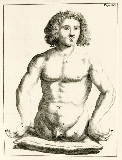 Przykład wrodzonych wad wrodzonych autorstwa Frederika Dekkersa, 1694 autorstwa Dutch School