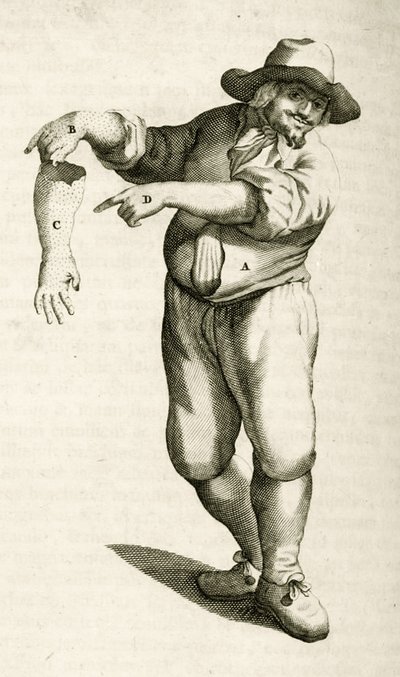 Usuwanie martwego naskórka z krostami, z Ćwiczeń praktycznych z metod medycznych Frederika Dekkersa, 1694 autorstwa Dutch School