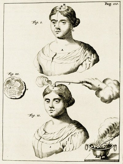 Leczenie chorego na padaczkę, z Ćwiczeń z praktyki lekarskiej Frederika Dekkersa, 1694 autorstwa Dutch School