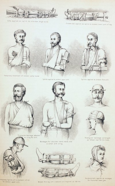 Tymczasowe leczenie złamań, c.1890 autorstwa English School