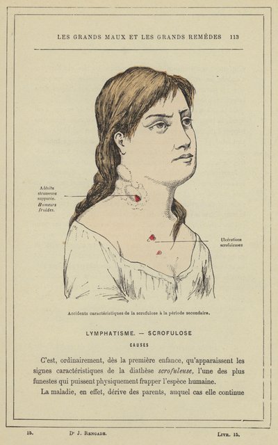 Charakterystyczne przypadki skrofulozy w okresie wtórnym (litografia kolorowa) autorstwa French School