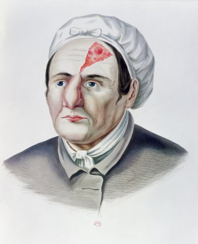 Po operacji przeszczepu skóry, z Selecta Praxis Medico-Chirurgica, Alexander Auvert, Paryż, 1856 autorstwa French School