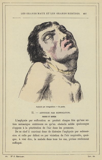 Uduszenie przez uduszenie, Wisielec (kolor lito) autorstwa French School