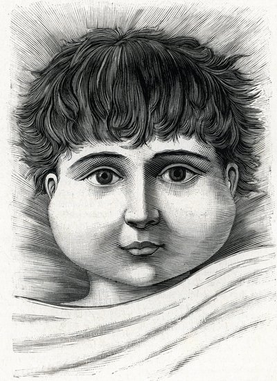 Dziecko z chorobą świnki (rycina) 1888 autorstwa French School