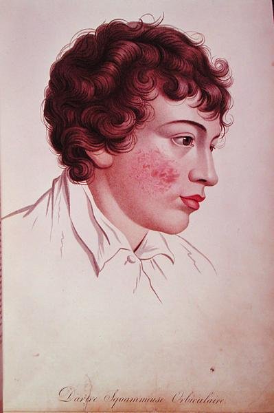 Sucha łata, z „Description des Maladies de la Peau” Barona Jeana Louisa Aliberta (1768-1837) autorstwa French School