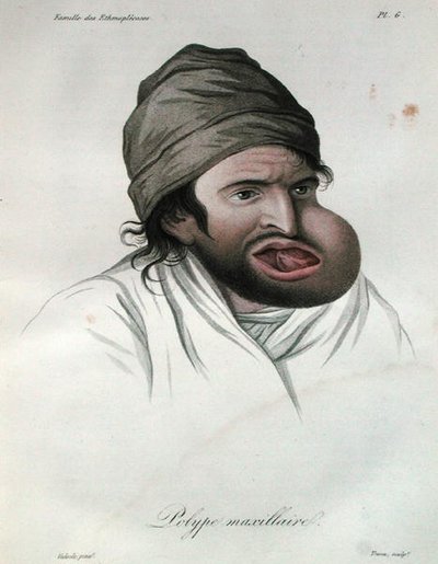 Polip szczękowy, z książki barona Jean Louis Alibert (1768-1837) 1817 (rycina kolorowana) autorstwa French School