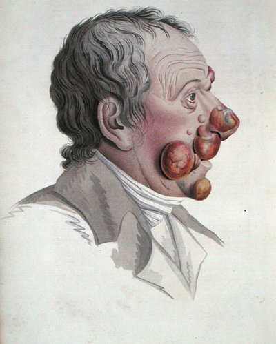 Mycosis Fongoide, z książki barona Jeana Louisa Aliberta (1768-1837) 1838 (rycina kolorowana) autorstwa French School